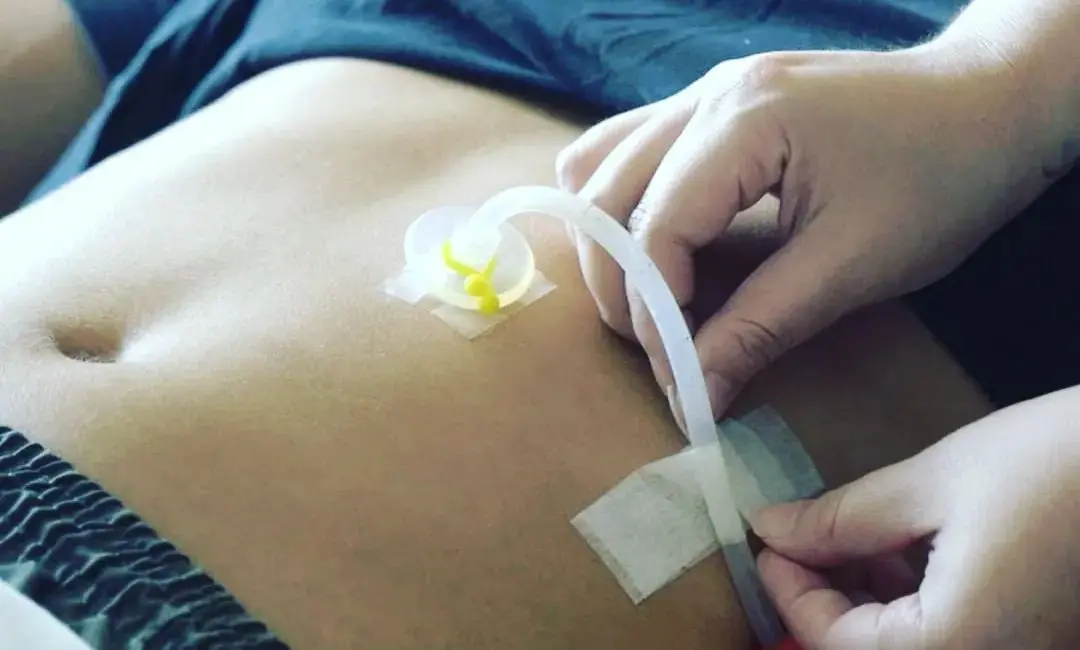 Gastrostomía Endoscópica (GEP)