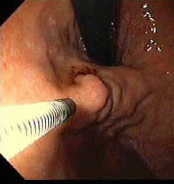 Esclerosis de Úlceras