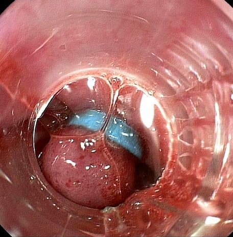 Ligadura de Várices